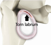 Shoulder Labrum Tear